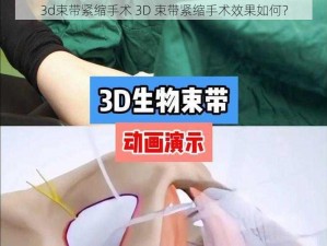 3d束带紧缩手术 3D 束带紧缩手术效果如何？